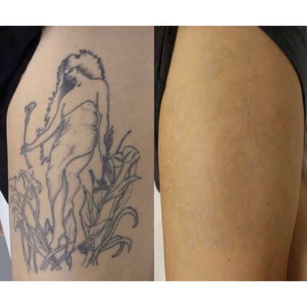 Удалить тату в Москве фото 6