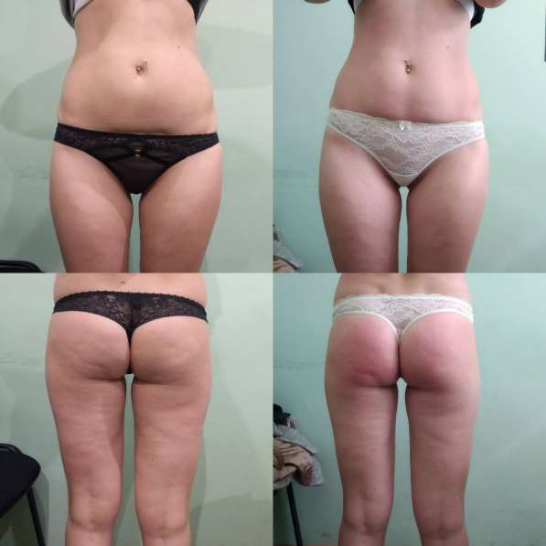 Антицеллюлитный массаж в Краснодаре фото 6