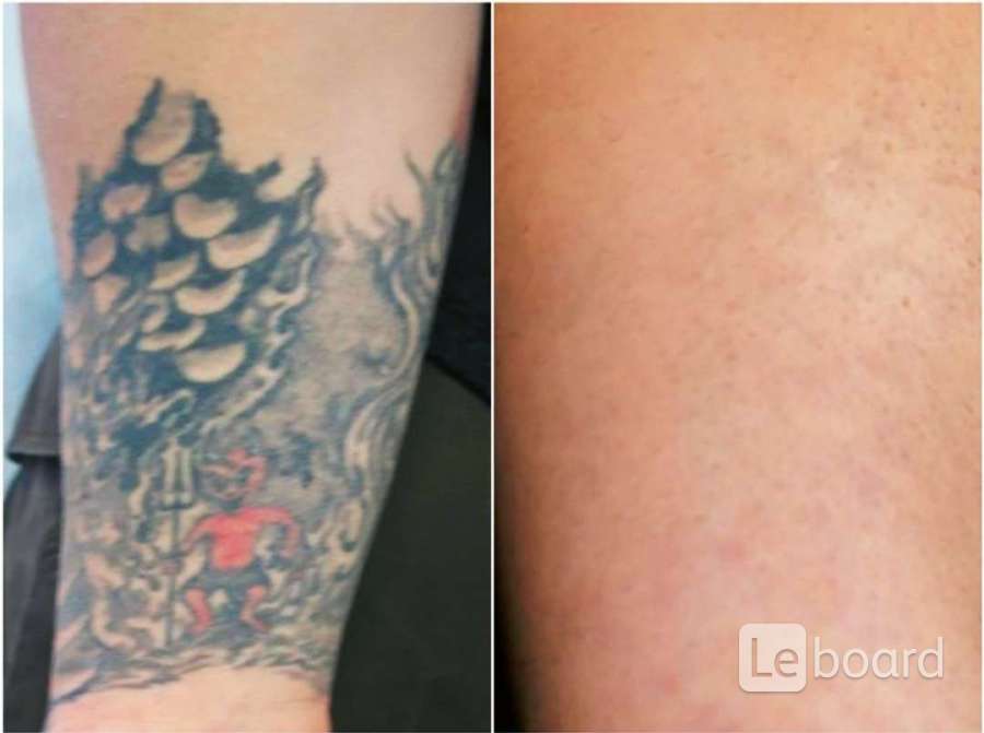 Убрать тату лазером. Сведение тату до и после. Удаление татуировок лазером. Сведение тату лазером до и после.